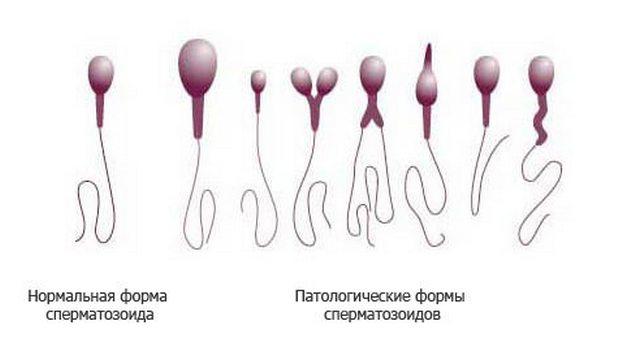 patologicheskie-formy-spermatozoidov.jpg
