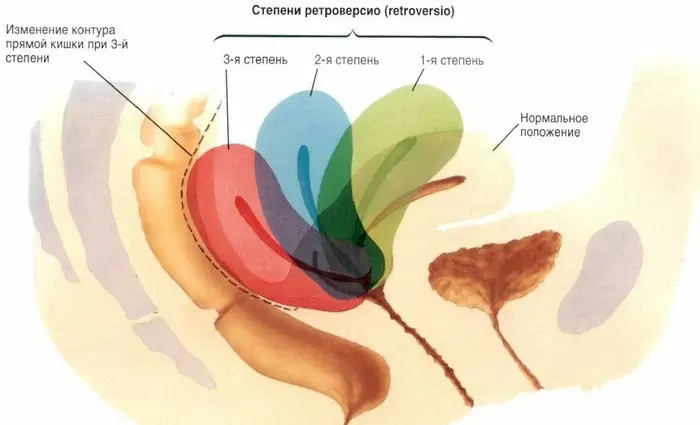 Морфология по Крюгеру (оценка внешнего строения сперматозоидов)