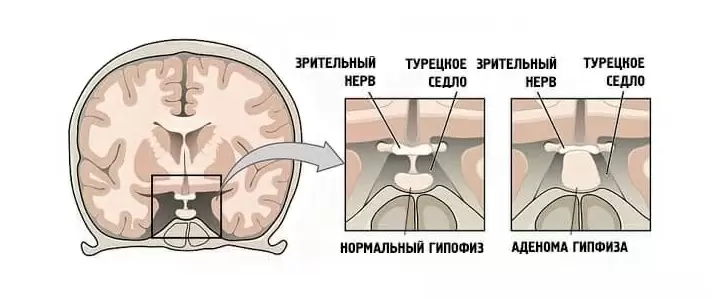 Аденома гипофиза головного мозга