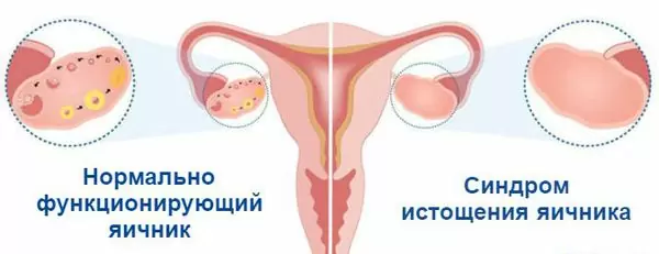 Синдром преждевременного истощения яичников