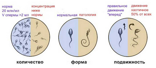 Астенозооспермия