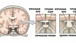 Аденома гипофиза головного мозга