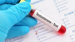Повышенный тестостерон у женщин