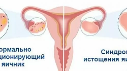 Синдром преждевременного истощения яичников
